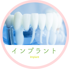 インプラント