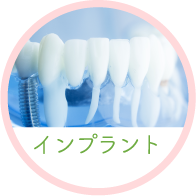 インプラント